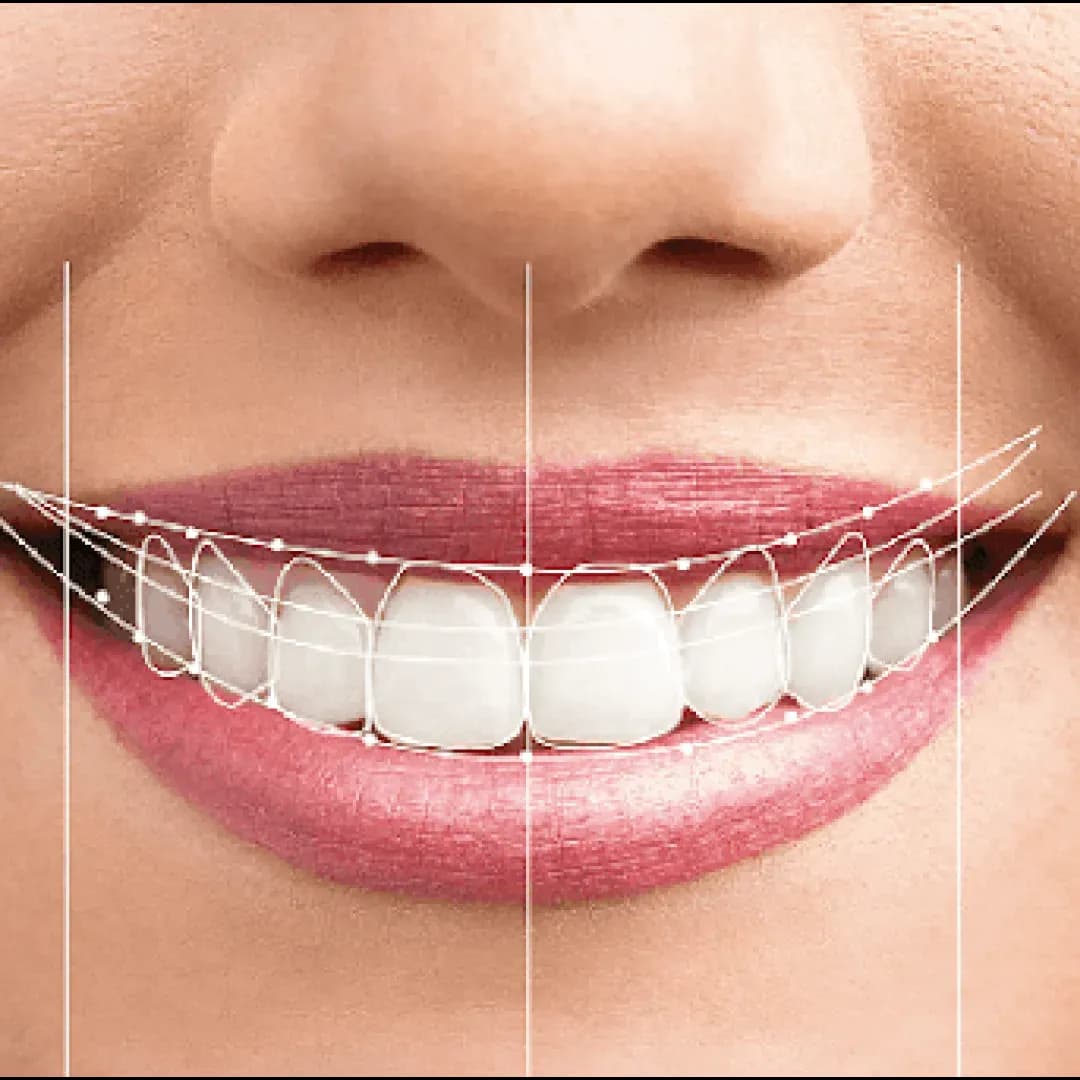 Smile Makeover