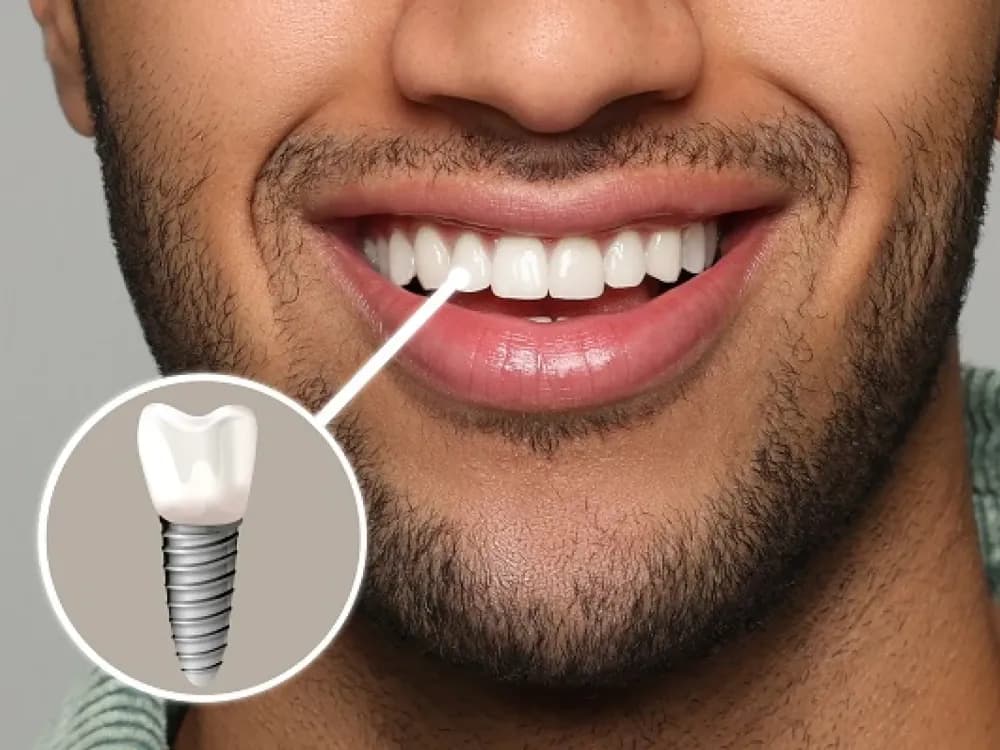 Dental Implants Hero Banner